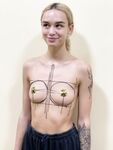 succubdiana)