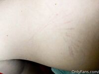 Erynrose